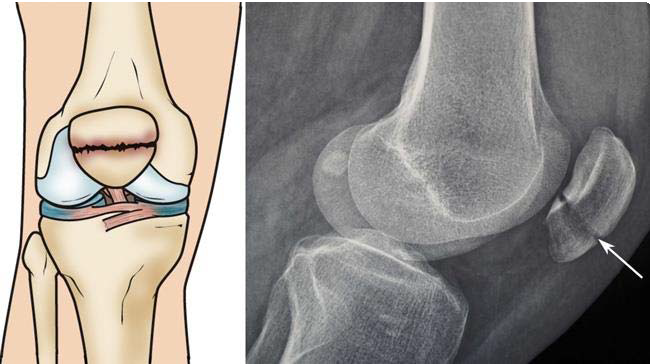 broken knee x ray