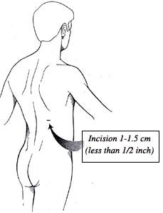 Ilustración de la incisión de la cirugía PNCL